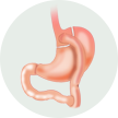 animation of a gastric bypass