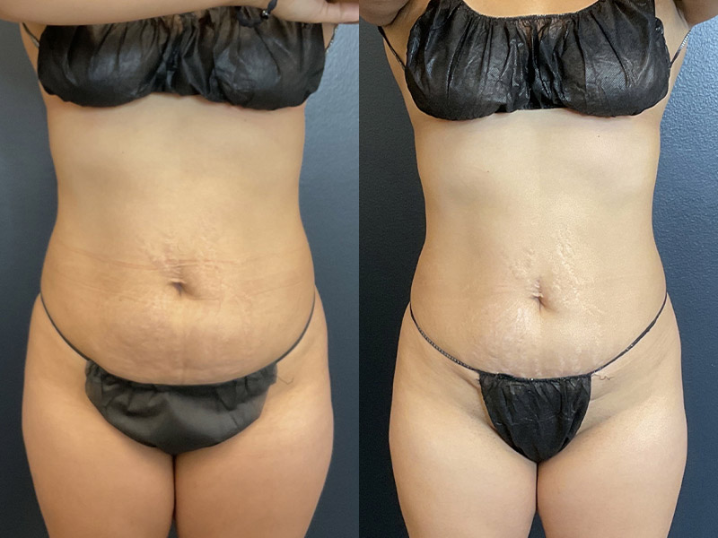 EMSCULPT Before & After Gallery - Patient 122606680 - Image 1