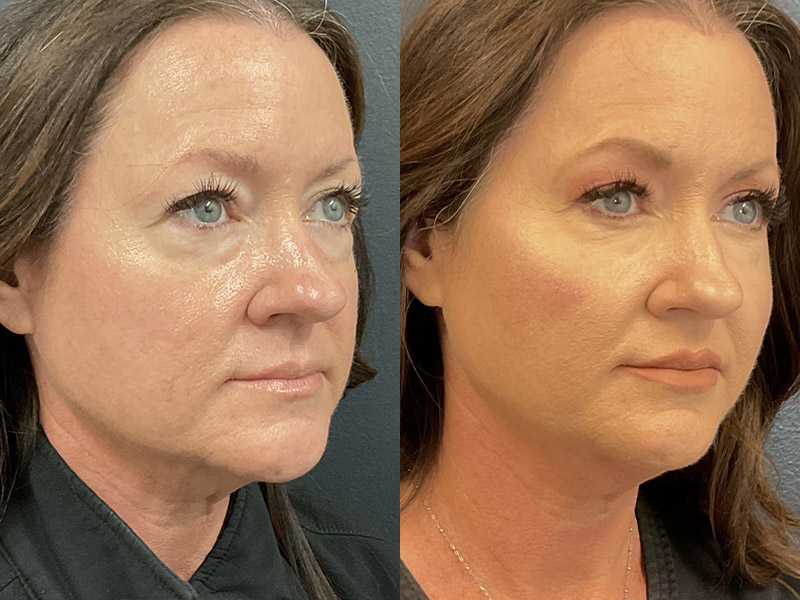 Dermal Fillers Before & After Gallery - Patient 122606688 - Image 1