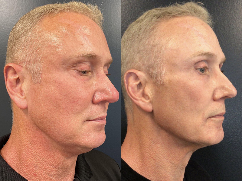 Morpheus 8 Skin Resurfacing Before & After Gallery - Patient 122606692 - Image 1