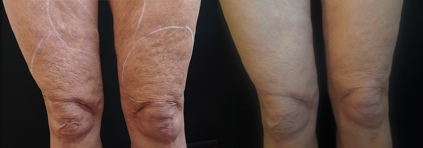 Morpheus 8 Skin Resurfacing Before & After Gallery - Patient 148257658 - Image 1