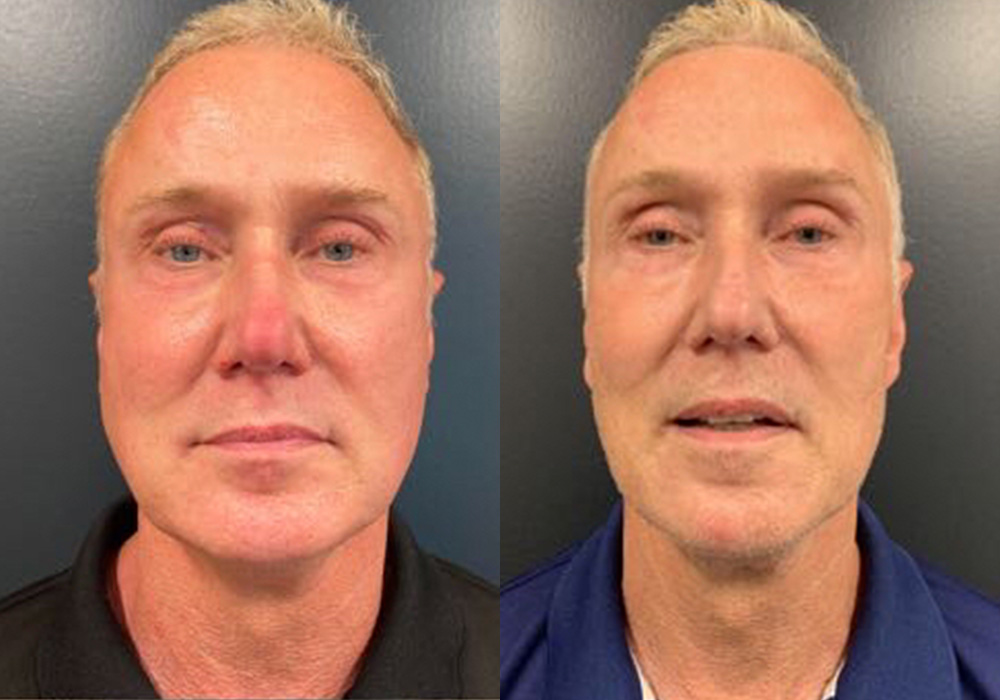 Morpheus 8 Skin Resurfacing Before & After Gallery - Patient 122606692 - Image 2