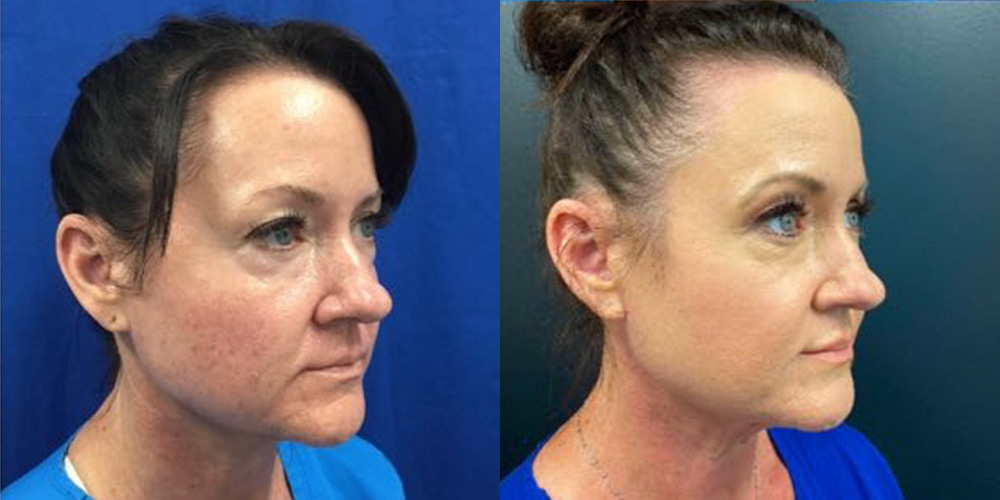 Morpheus 8 Skin Resurfacing Before & After Gallery - Patient 148257660 - Image 1